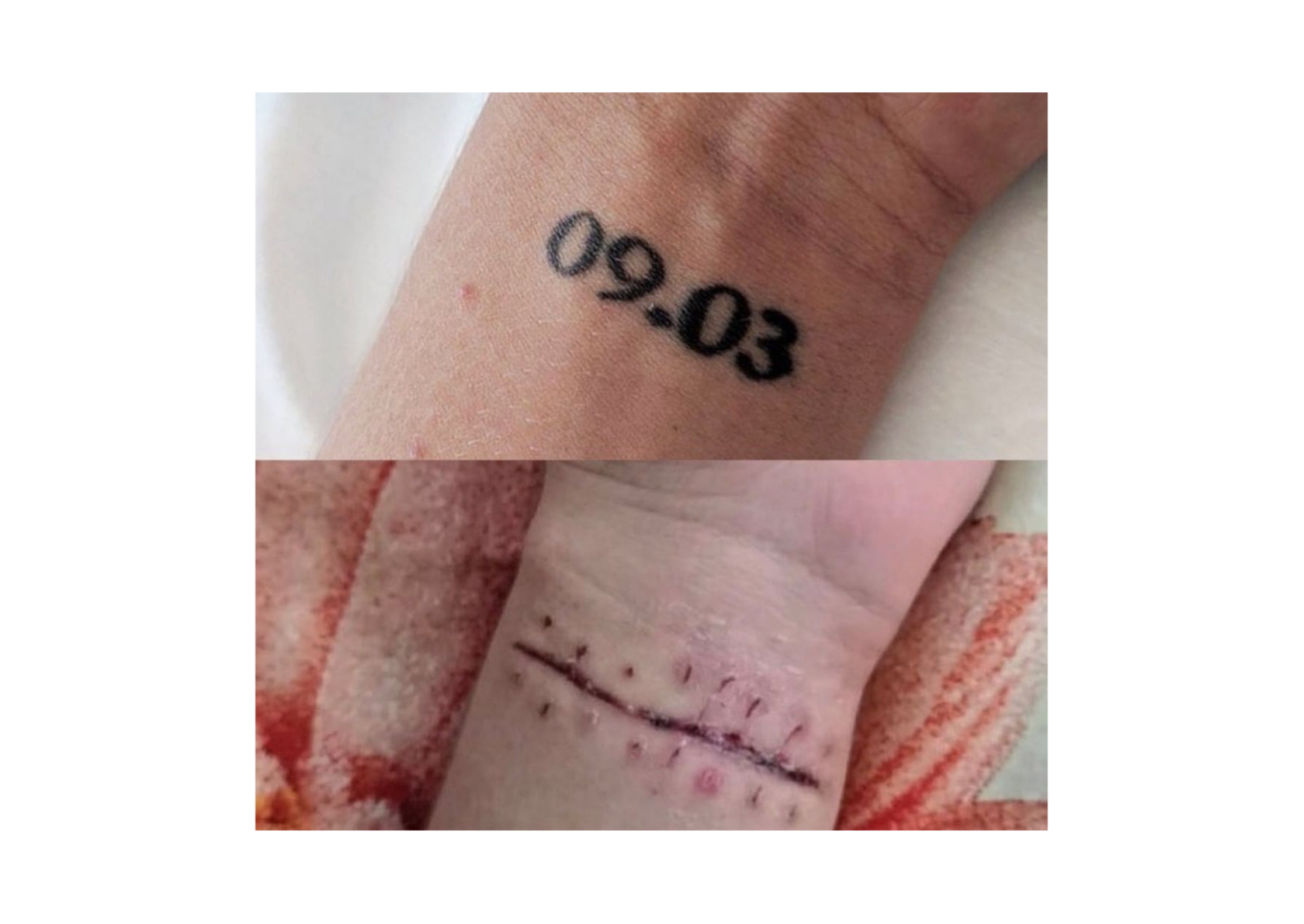 Scarring left by surgical excision of a tattoo compared with laser removal