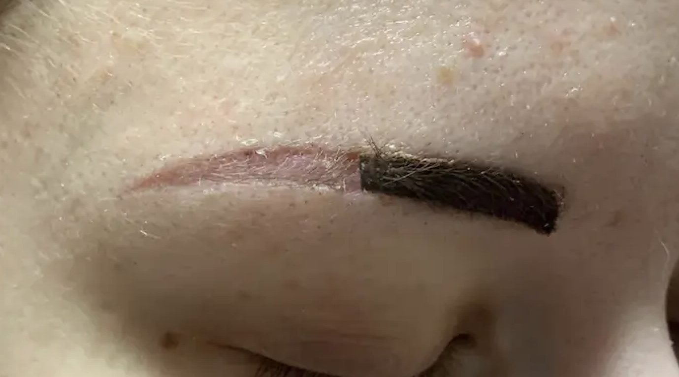 Skin changes after repeated permanent makeup procedures — scarring and regeneration limits