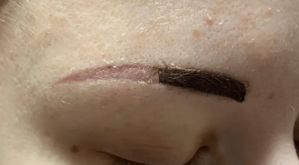 How Many PMU Procedures Can The Skin&nbsp;Endure?