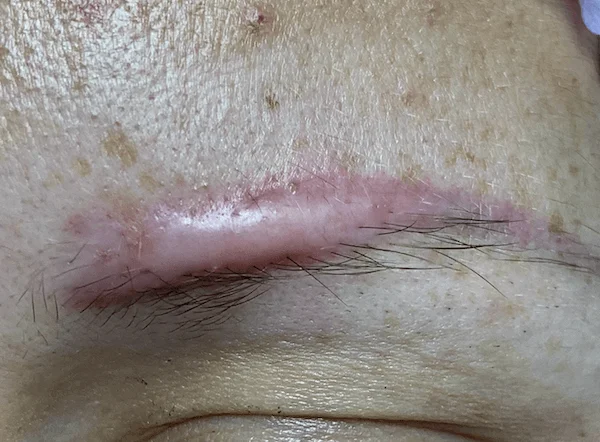 Chemical removers for permanent makeup — myths and reality about how they work