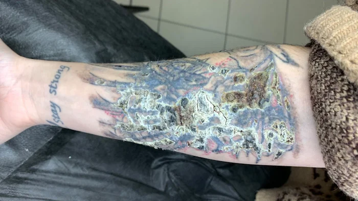 Complication after laser tattoo removal in a complex case sent by a course graduate