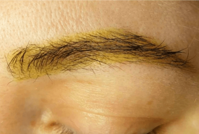 Why Do Eyebrows Turn Yellow After Laser Removal of Permanent Eyebrow Makeup?