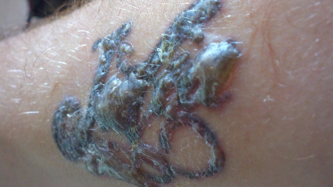 Blistering of skin after laser tattoo removal — a complication, not a normal reaction